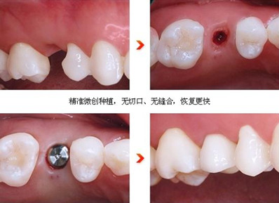 牙齿最新技术，重塑口腔健康的未来之路