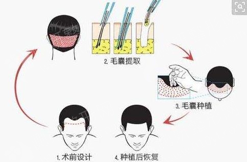 克隆毛囊技术革新引领植发新纪元，最新消息揭秘未来趋势