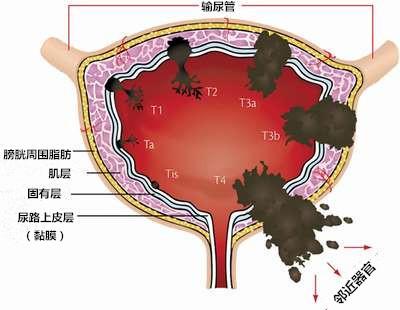 膀胱肿瘤最新治疗方法，探索前沿技术与应用理解